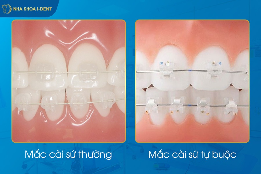 niềng răng chỉnh khớp cắn