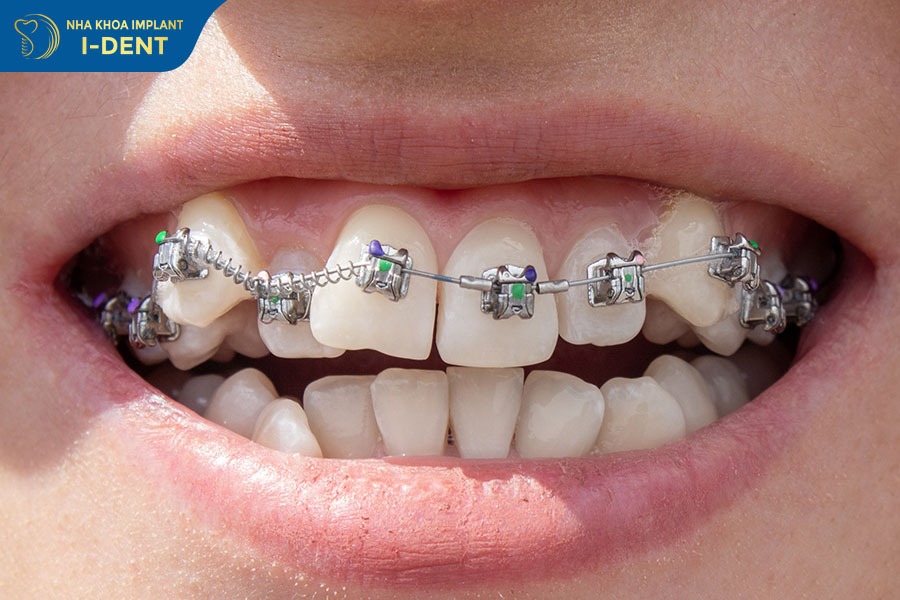 Niềng răng khấp khểnh