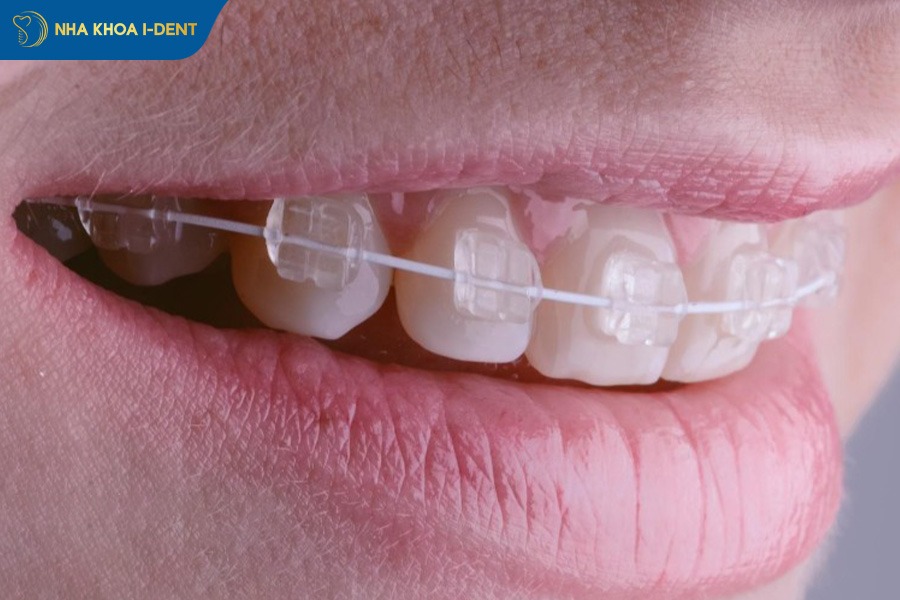 Niềng răng khớp cắn sâu bằng mắc cài sứ