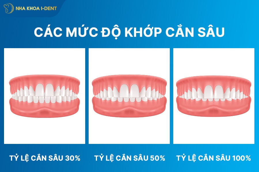 niềng răng khớp cắn sâu