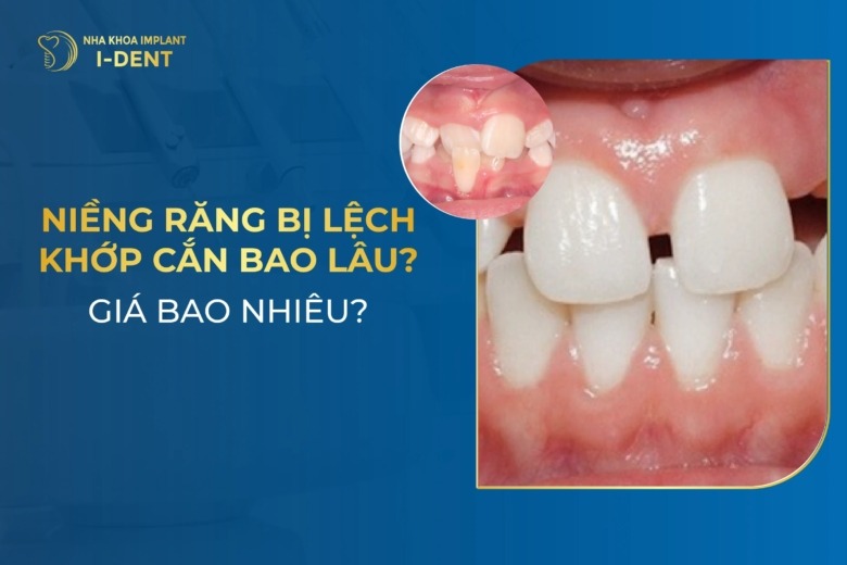 Niềng Răng Bị Lệch Khớp Cắn Bao Lâu? Giá Bao Nhiêu?