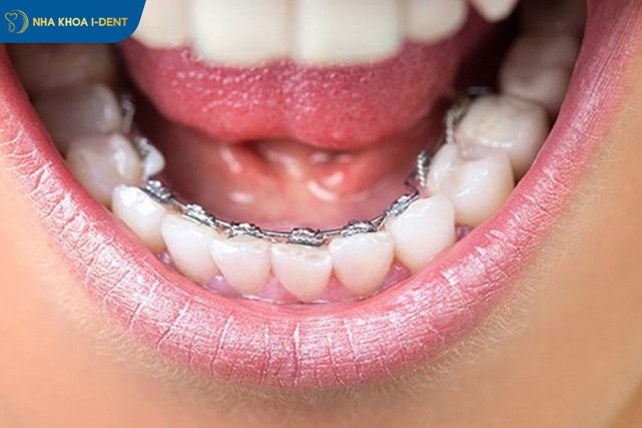 niềng răng lệch khớp cắn bao nhiêu tiền