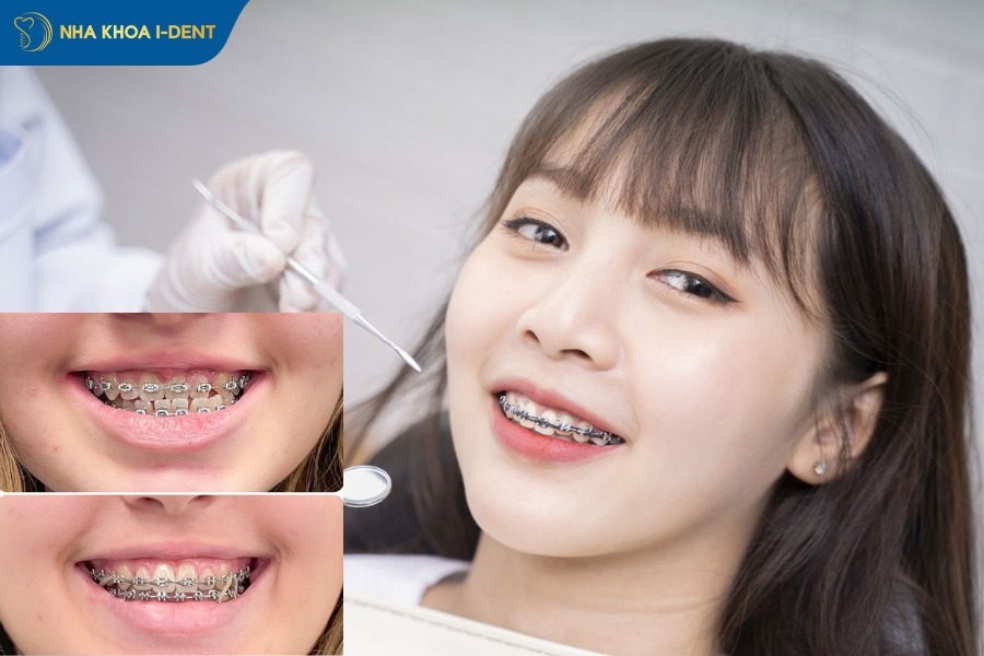 niềng răng móm bằng mác cài kim loại