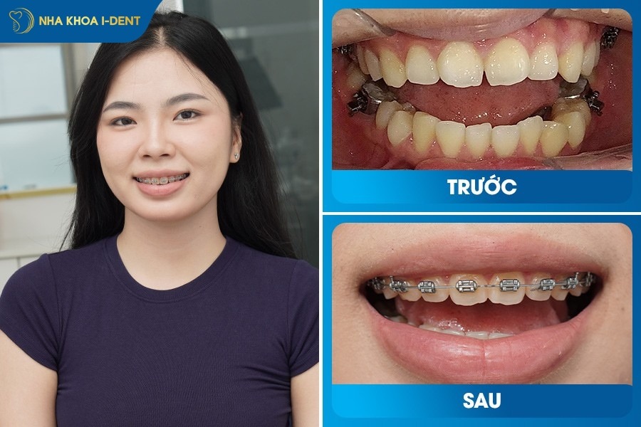 niềng răng móm mất bao lâu