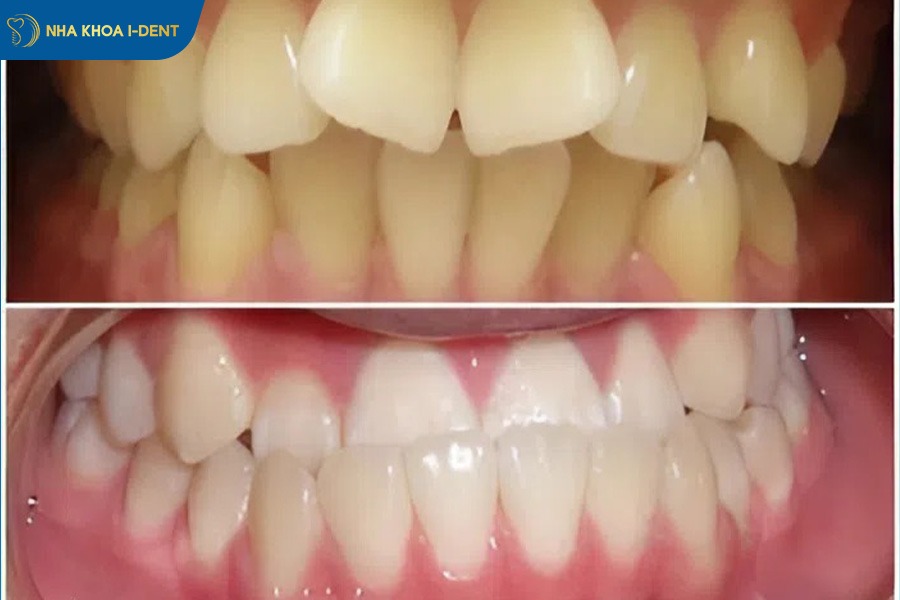 niềng răng sai khớp cắn