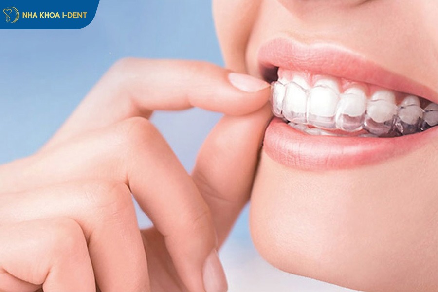 Niềng răng trong suốt invisalign