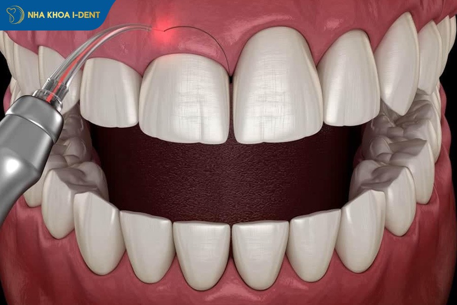 niềng răng xong bị hở lợi