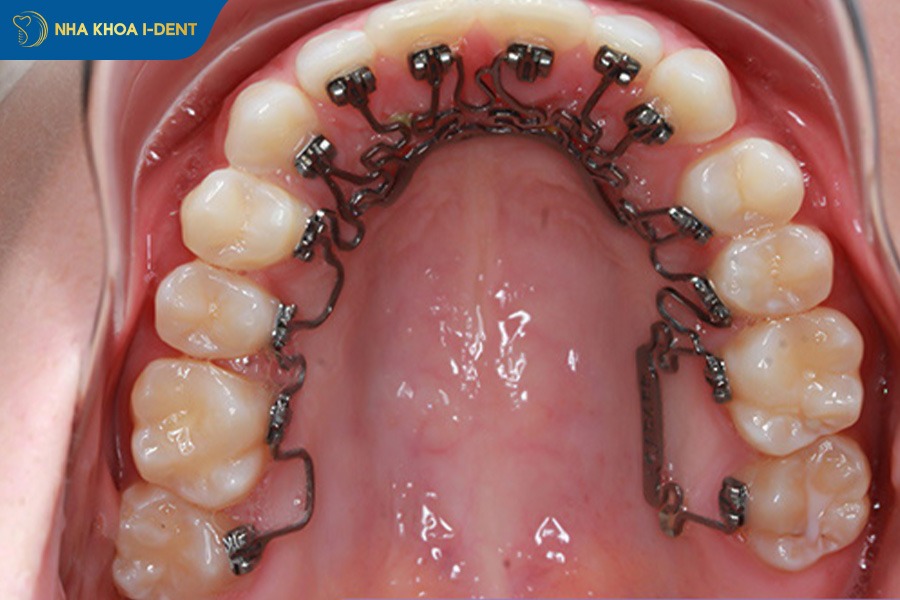 niềng răng loại nào tốt nhất