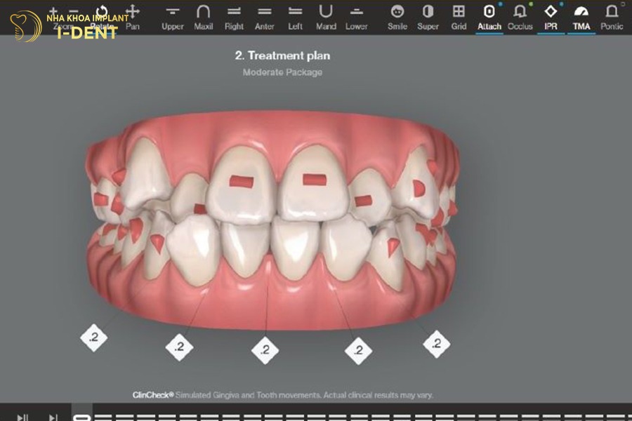 quá trình niềng răng trong suốt