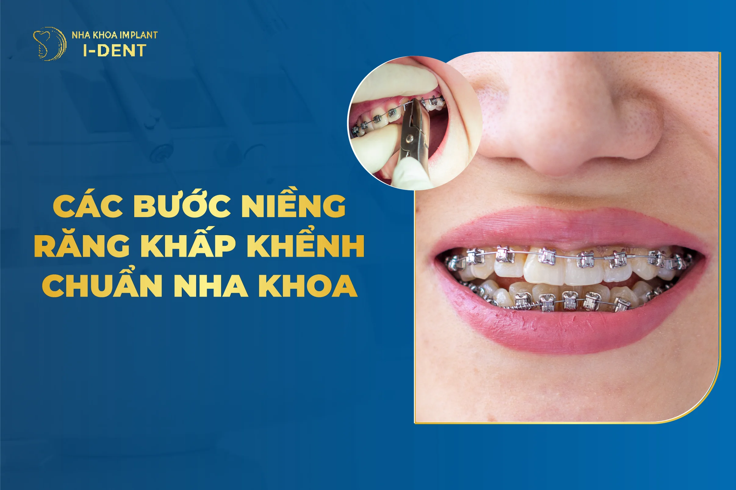 Các bước trong quy trình niềng răng khấp khểnh chuẩn y khoa