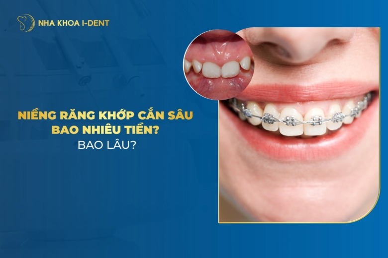 Niềng Răng Khớp Cắn Sâu Bao Nhiêu Tiền? Bao Lâu?