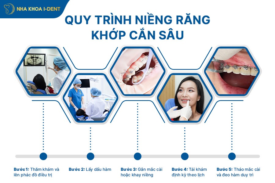Quy trình niềng răng khớp cắn sâu gồm 5 bước