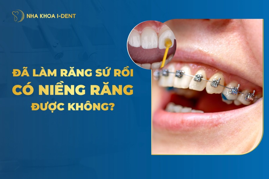 [Tư Vấn] Bọc Răng Sứ Có Niềng Được Không?
