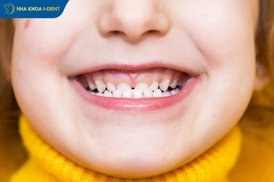 nguyên nhân gây móm răng