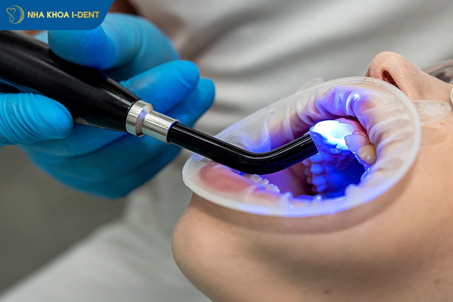 Phục hồi gãy răng cửa bằng trám răng