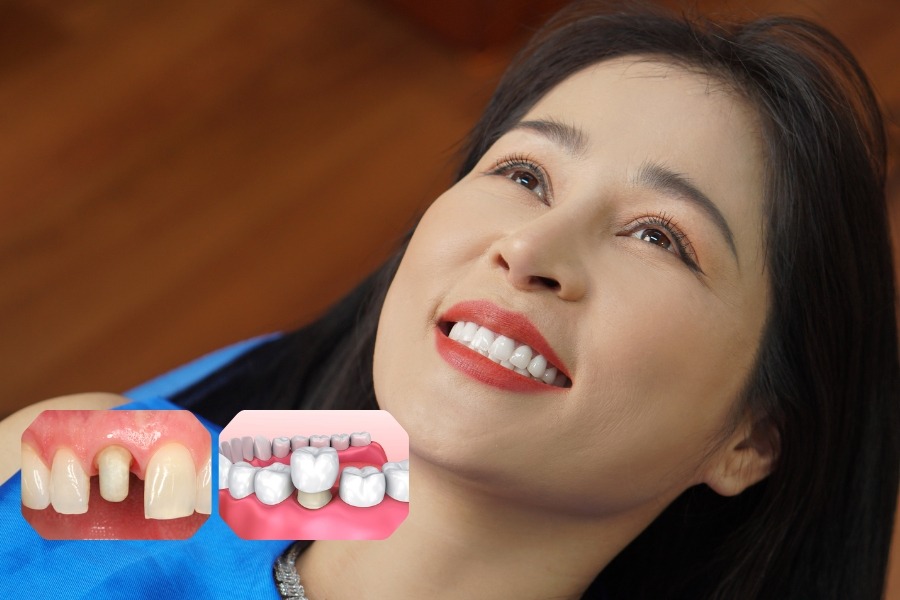 trong-rang-khenh-bao-nhieu-tien