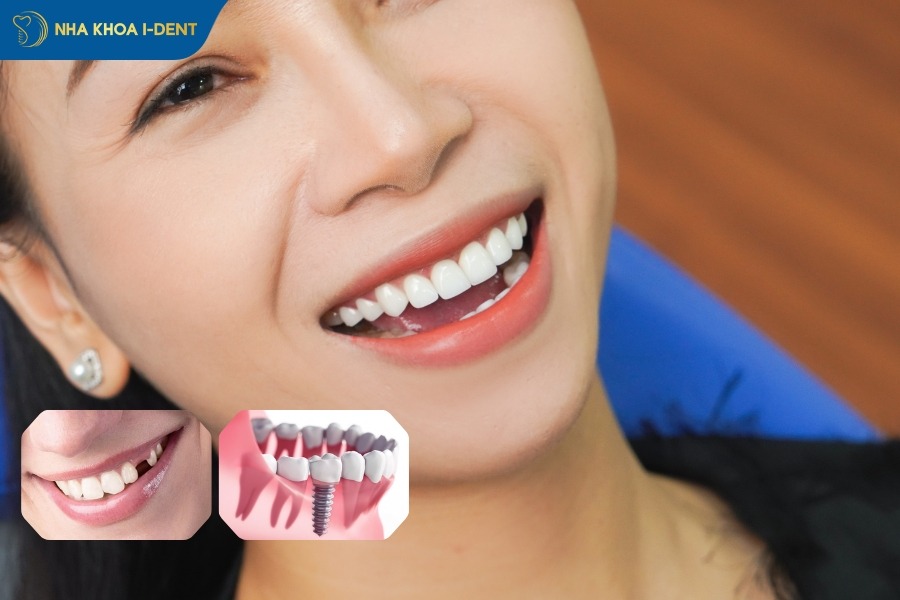 Giá làm răng khểnh bằng phương pháp trồng răng implant từ 35 - 135 triệu.