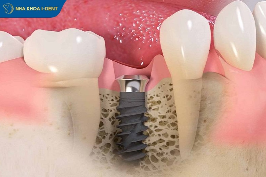 tru-rang-megagen-implant-phu-hop-nguoi-viet