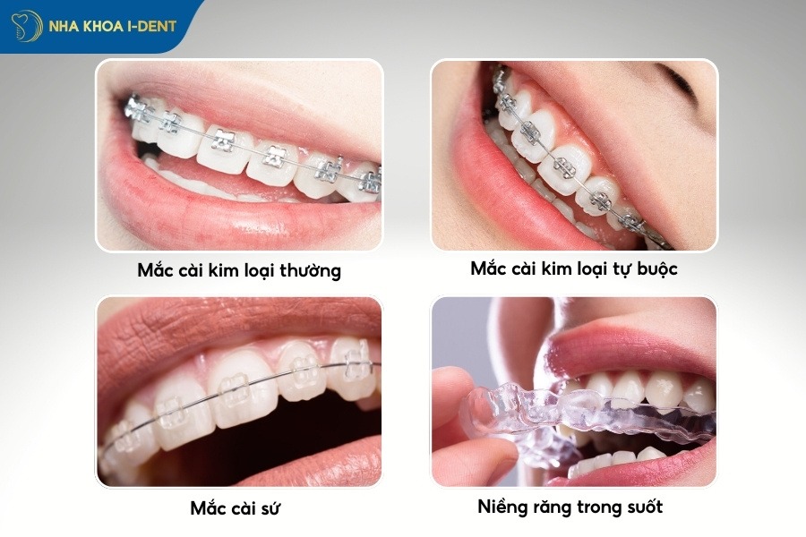 bảng giá niềng răng rẻ nhất