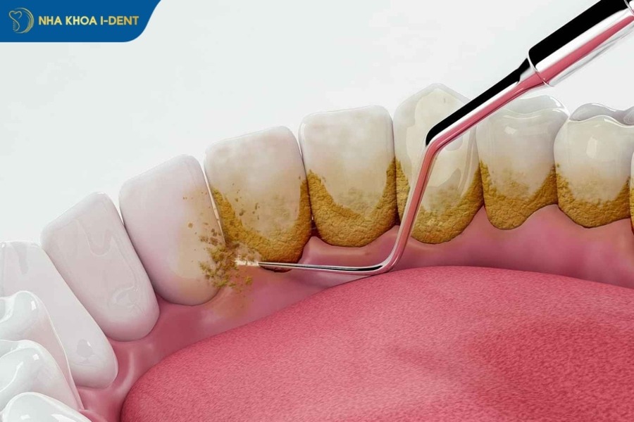 cạo vôi răng giá