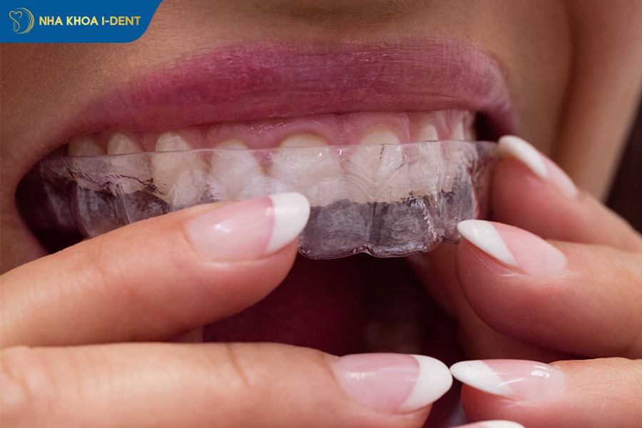 giá niềng răng tháo lắp