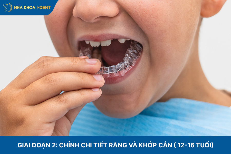 Giai đoạn 2: Chỉnh chi tiết răng và khớp cắn