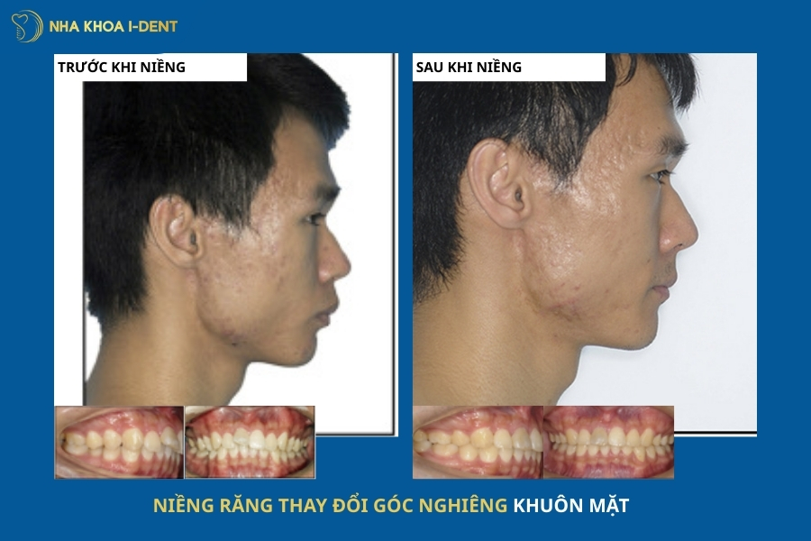 góc nghiêng trước và sau khi niềng răng