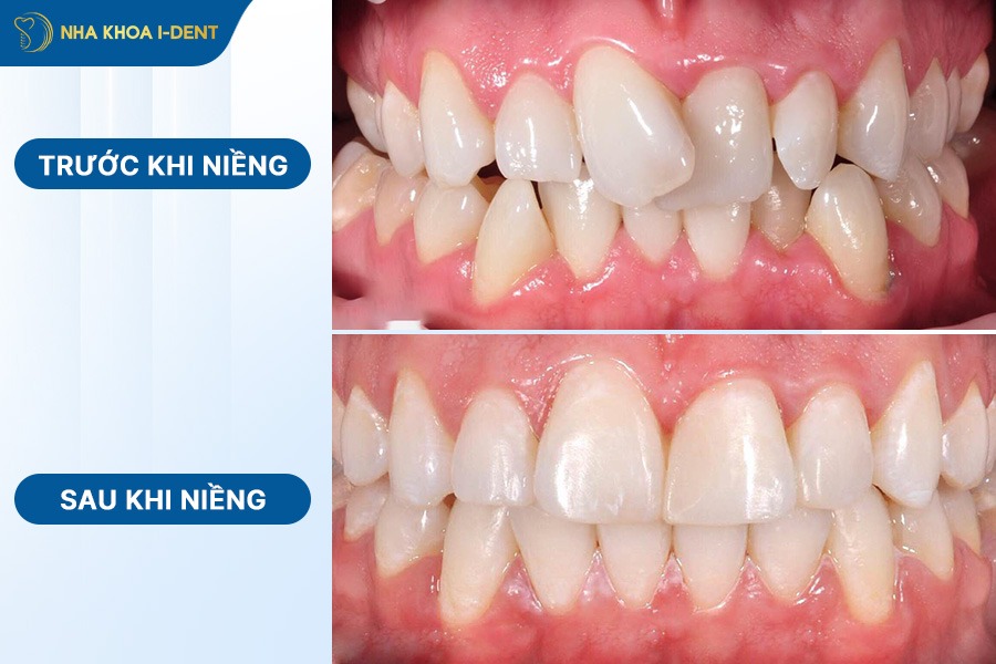 hình ảnh niềng răng trong suốt