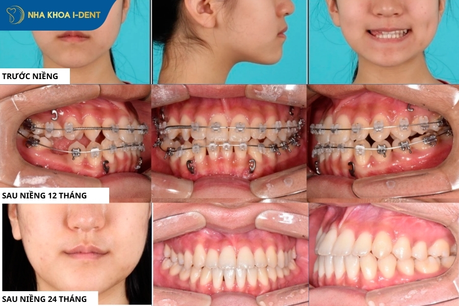 hình ảnh trước và sau khi niềng răng góc nghiêng