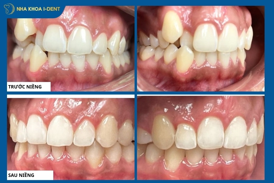 hình ảnh trước và sau khi niềng răng khểnh