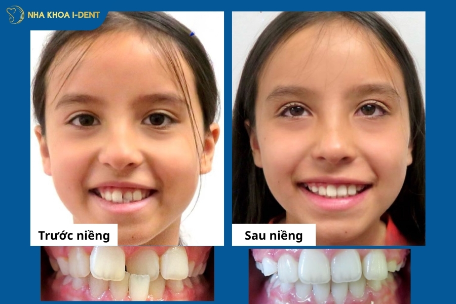 hình ảnh trước và sau khi niềng răng trẻ em