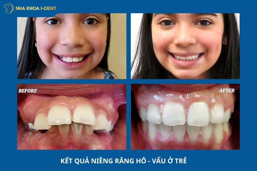 trước và sau khi niềng răng hô ở trẻ