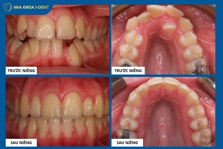 hình ảnh trước và sau khi niềng răng hô