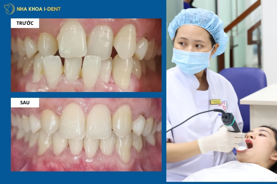 kết quả niềng răng trong suốt