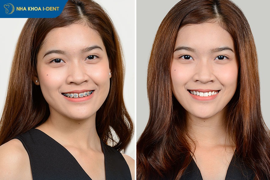 niềng răng mắc cài sứ và kim loại