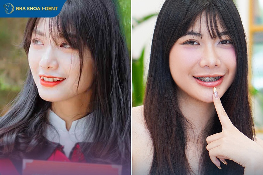 niềng răng mắc cài sứ và kim loại