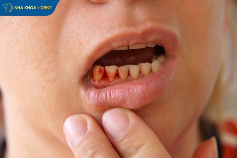 lấy cao răng giá bao nhiêu