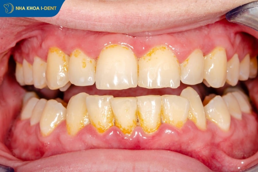 lấy vôi răng