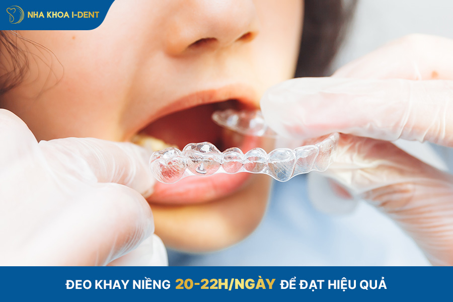 Lưu ý khi niềng răng trong suốt cho trẻ em