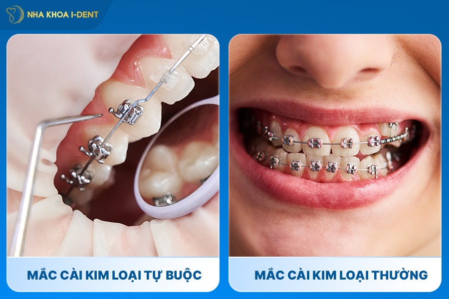 mắc cài kim loại thường và tự buộc