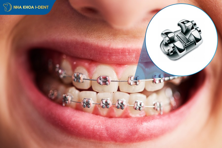 Mắc cài kim loại thường