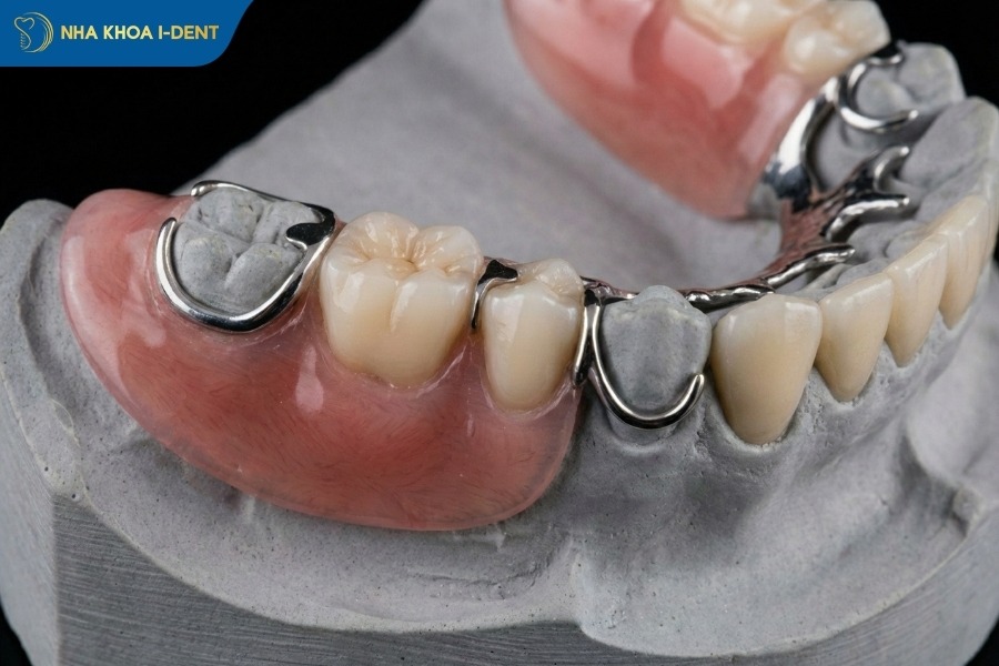 mất răng số 6 lâu năm