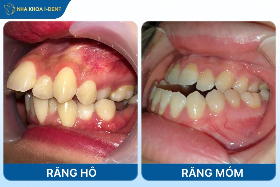 Nếu răng hô và răng móm sẽ cần nhổ răng để tạo khoảng trống kéo lùi răng