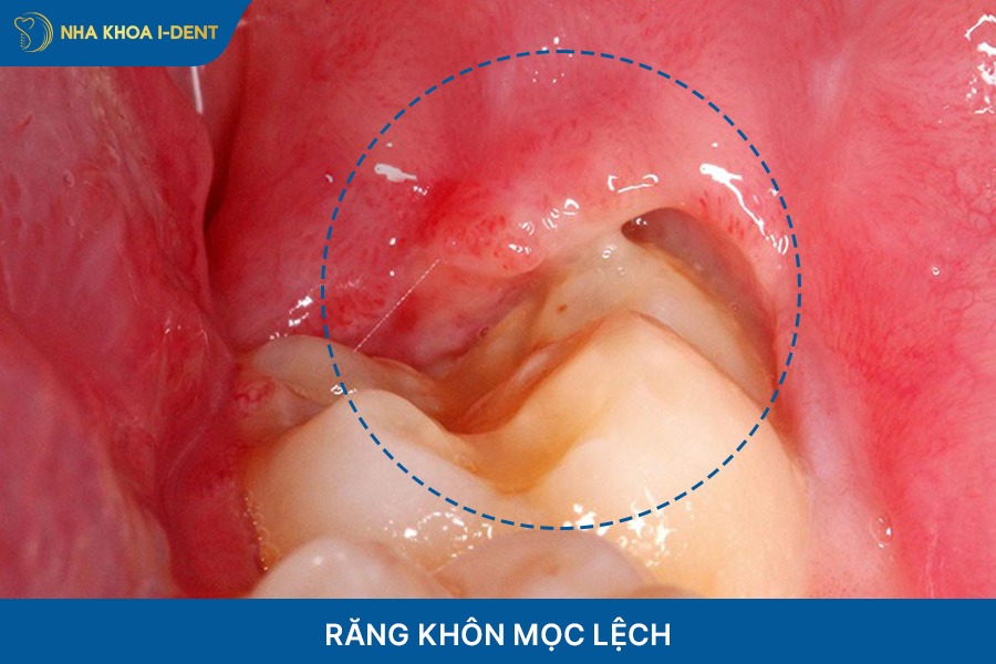 Nhổ răng khôn mọc lệch để tạo khoảng trống cho răng dịch chuyển