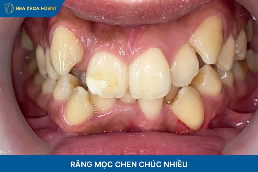 Trường hợp răng mọc chen chúc nhiều sẽ cần nhổ răng khi niềng trong suốt