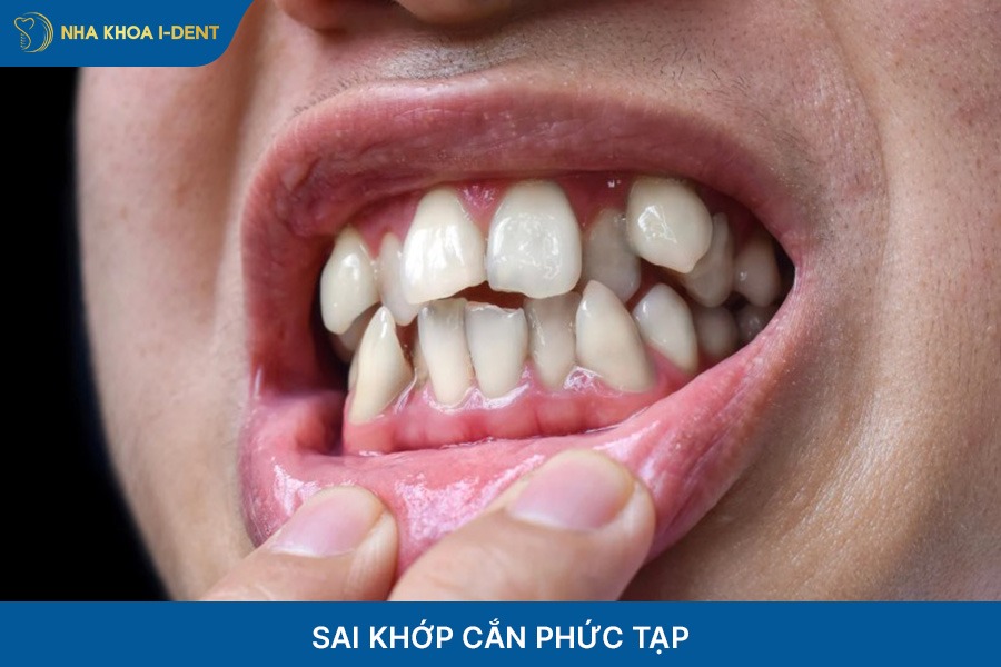 Sai khớp cắn phức tạp bác sĩ sẽ chỉ định nhổ răng
