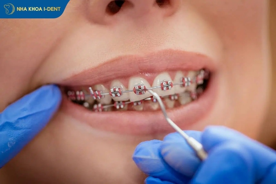 niềng răng bao lâu mới tháo