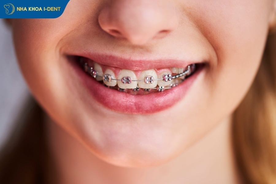 niềng răng bao lâu thì có kết quả
