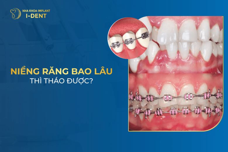 Niềng răng mất khoảng bao lâu thì tháo? Nên tháo niềng sớm không?