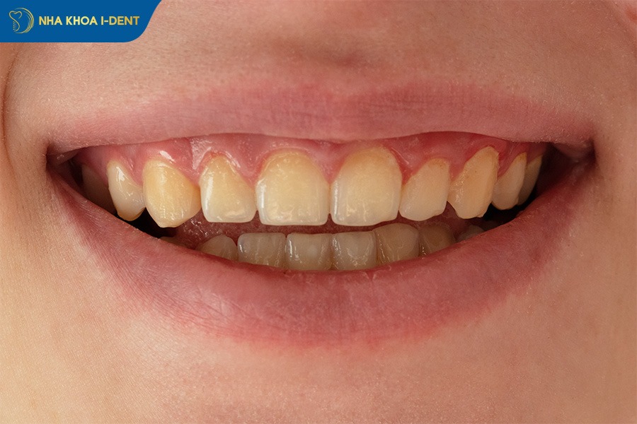 niềng răng bị đau ê